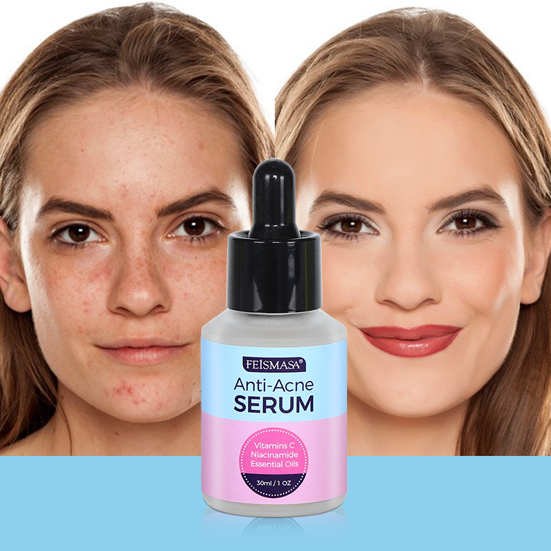 Skincare Skin Care Serum Acne Pimple Face Serum Anti Acne and Moisturizer